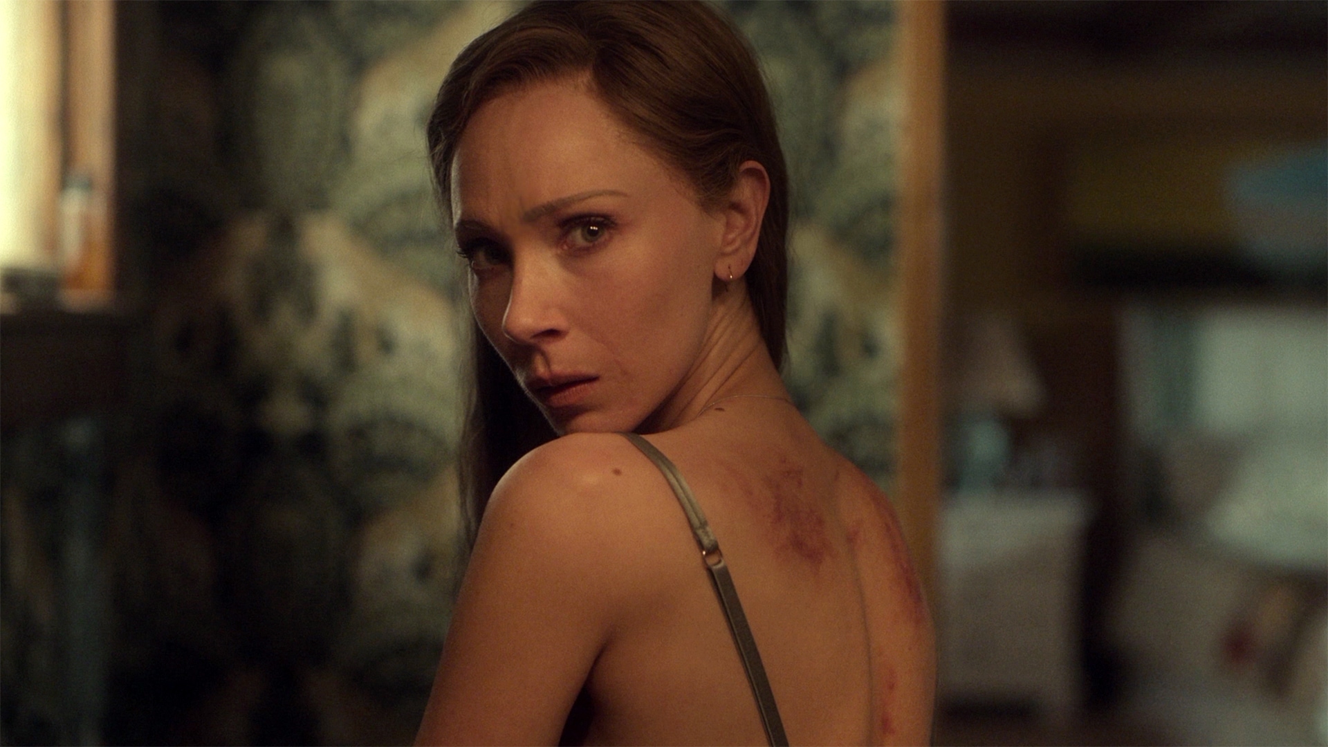Woman with back turned with bruise on back